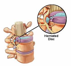 show-herniated-disc